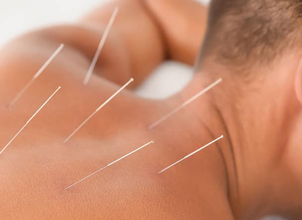 acupuncture sydney