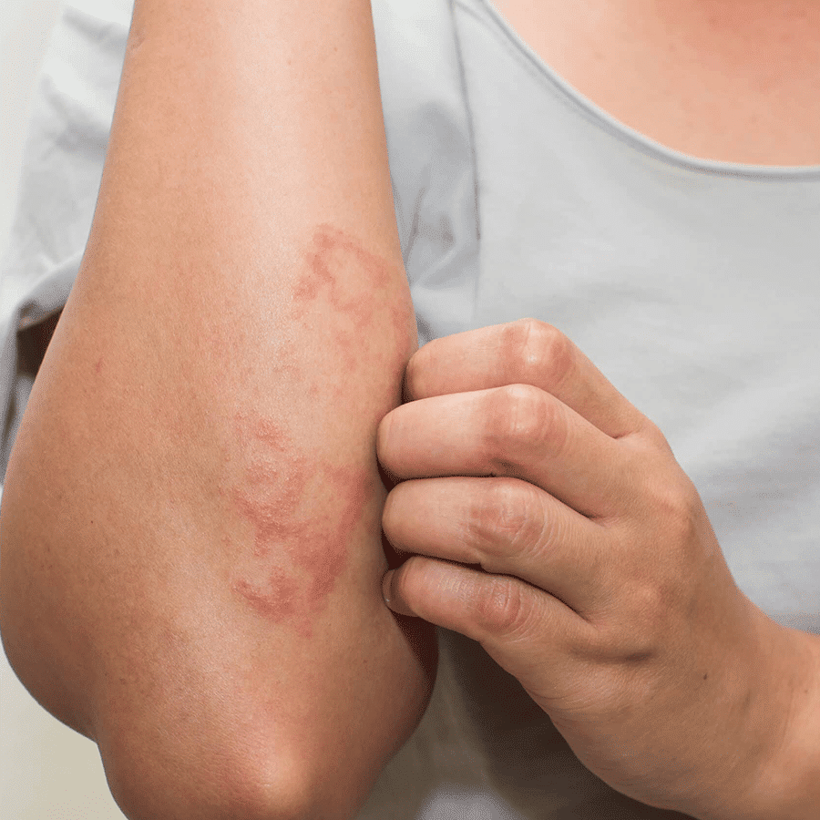eczma treatment