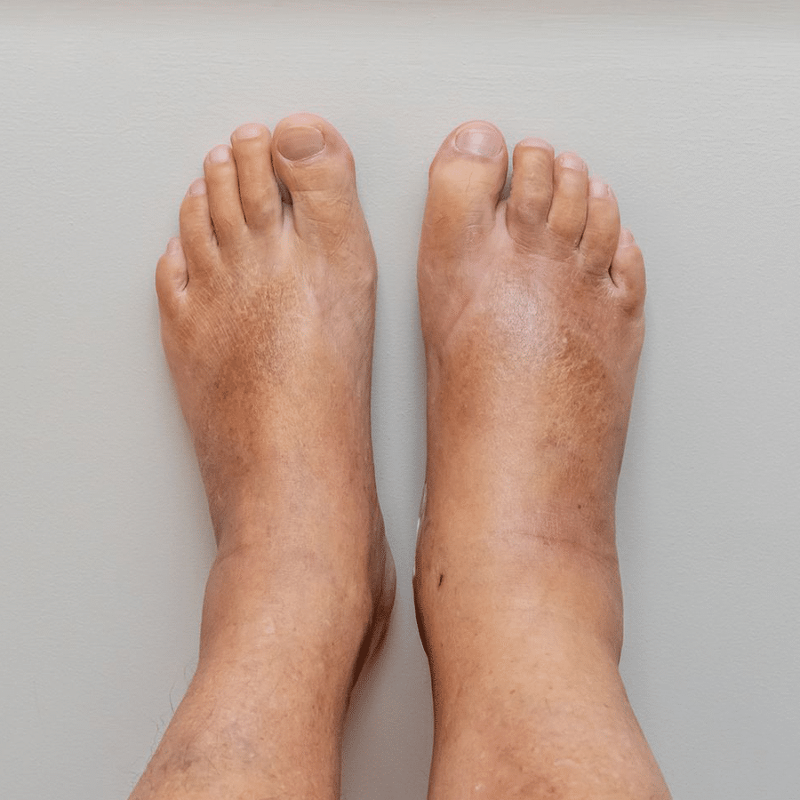 inflammation treatment